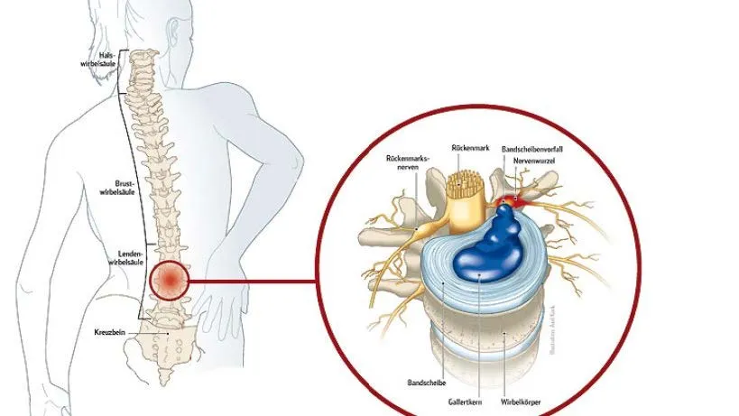 Prävention Rückenschmerzen
